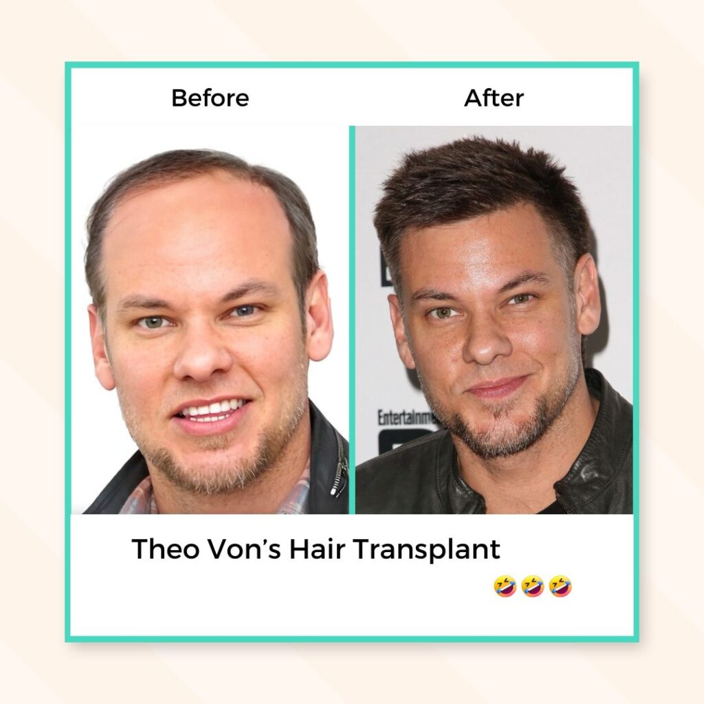 Theo Von’s Hair Transplant