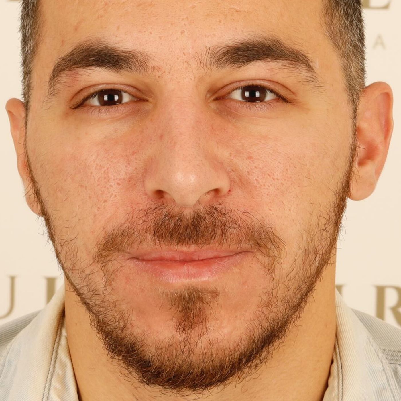 beard transplant at sule hair