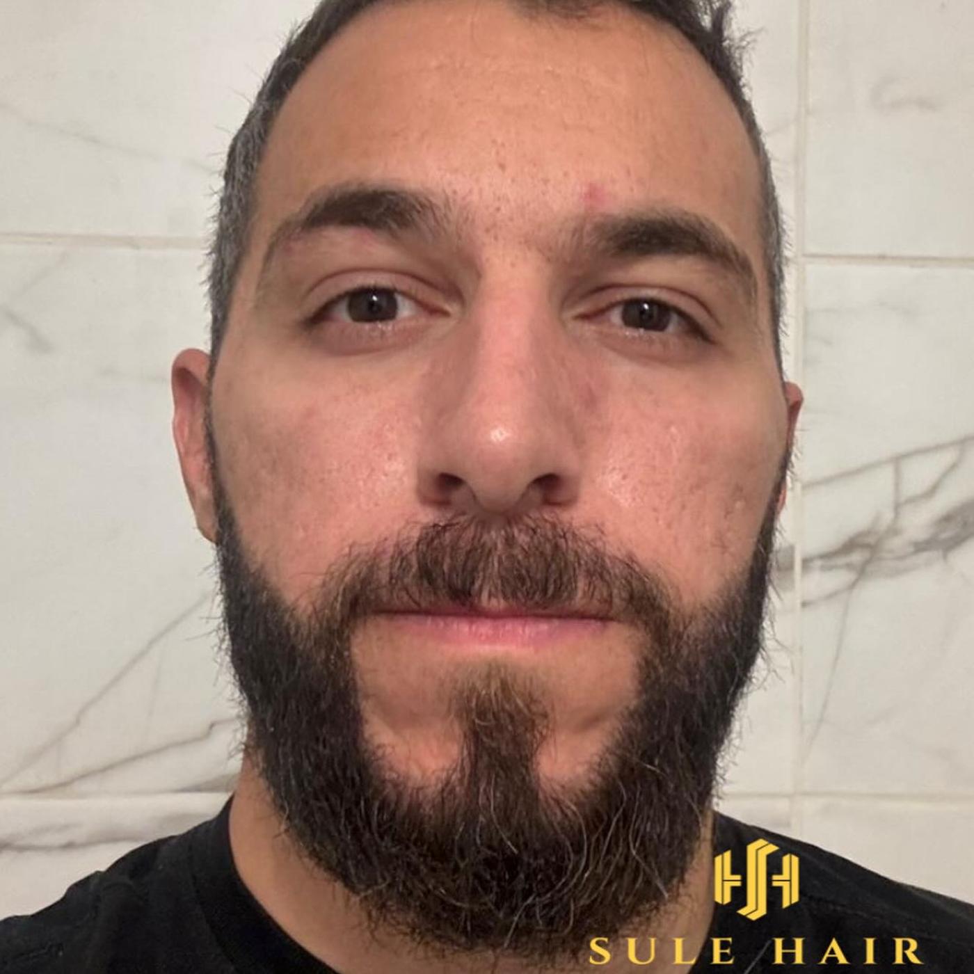 beard transplant at sule hair clinic