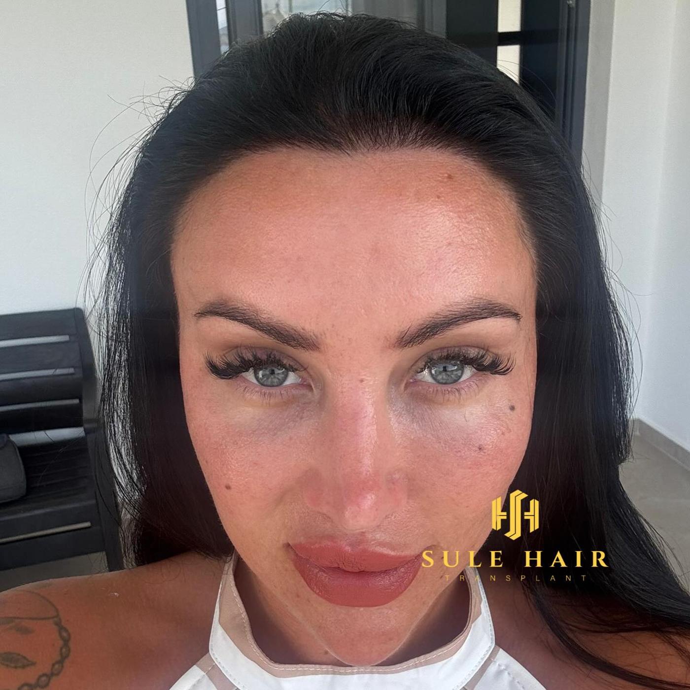 woman hair transplant after