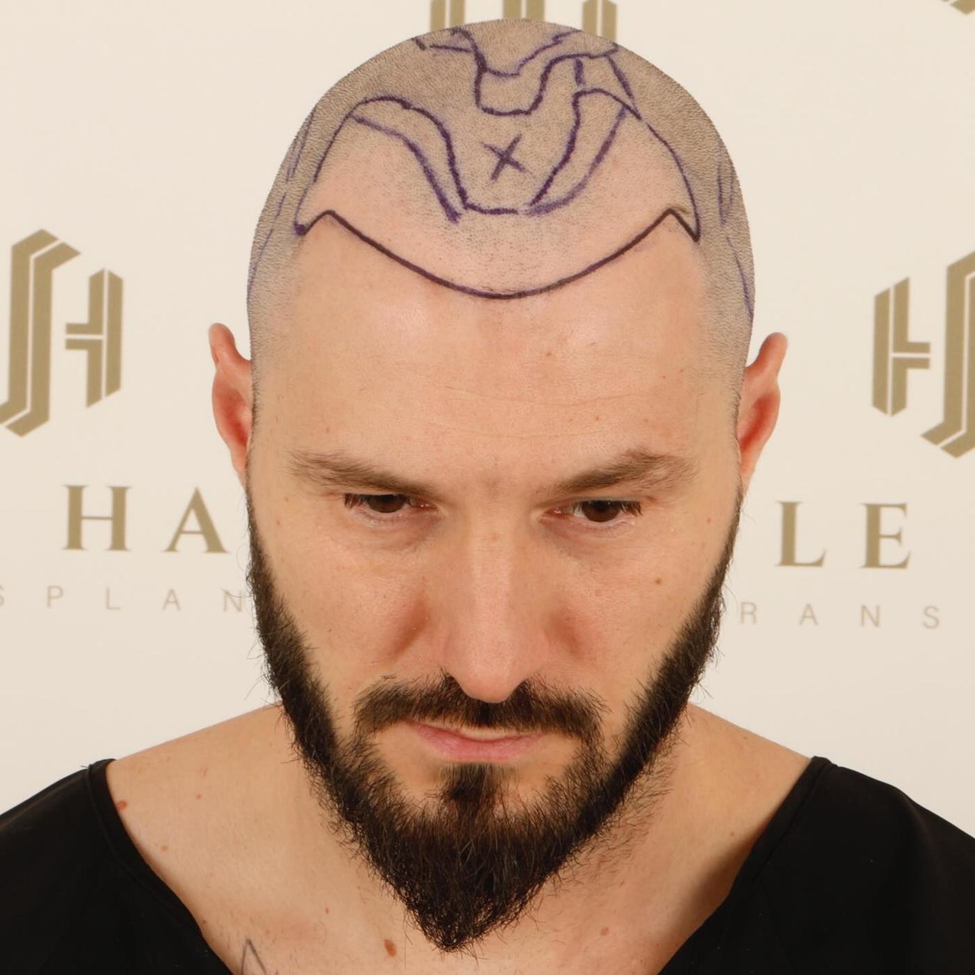 hair transplant before