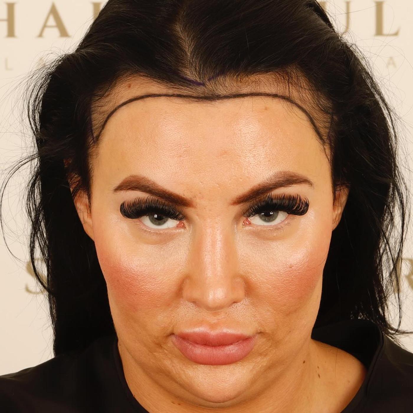 female hair transplant before