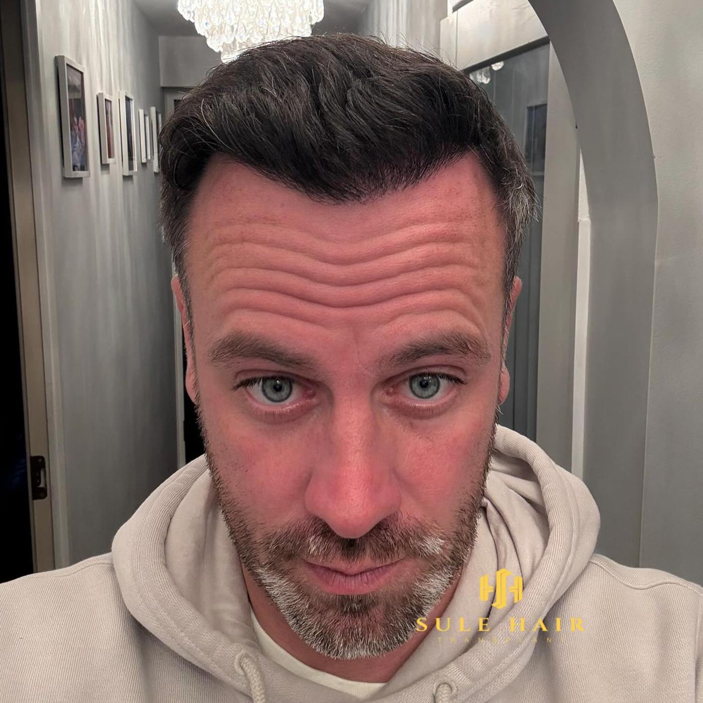 hairline after hair transplant at sule hair