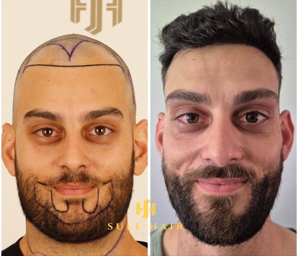 sule hair and beard transplant