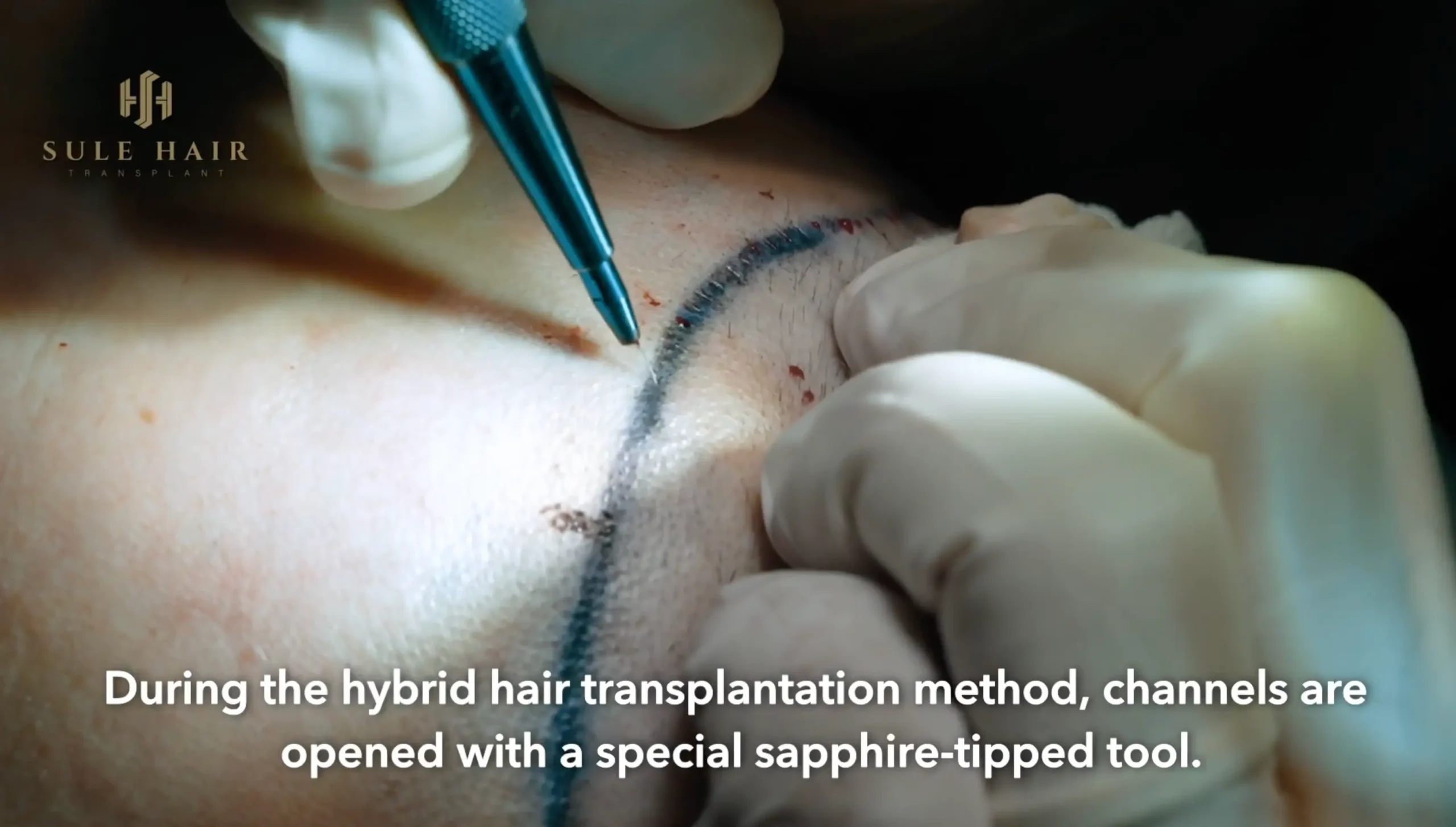 hybrid method hair transplant