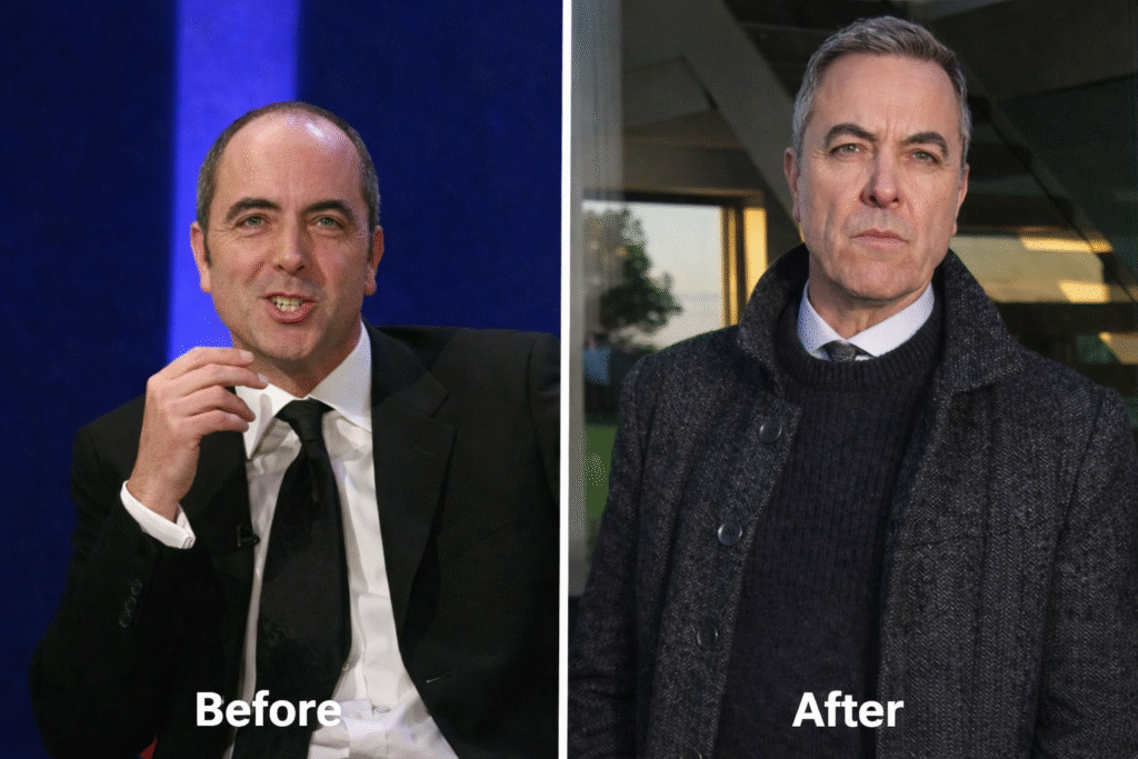 James Nesbitt Hair Transplant
